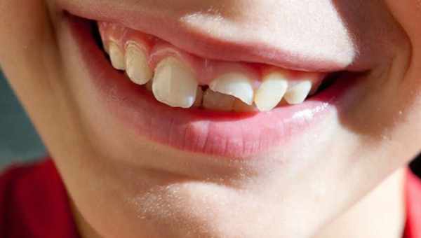 К чему снится, что крошатся зубы: у тебя или у кого-то из близких. Основные толкования, к чему снится, что крошатся зубы