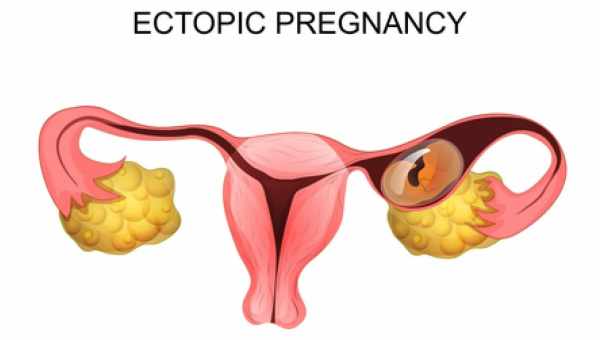 Что такое внематочная беременность?