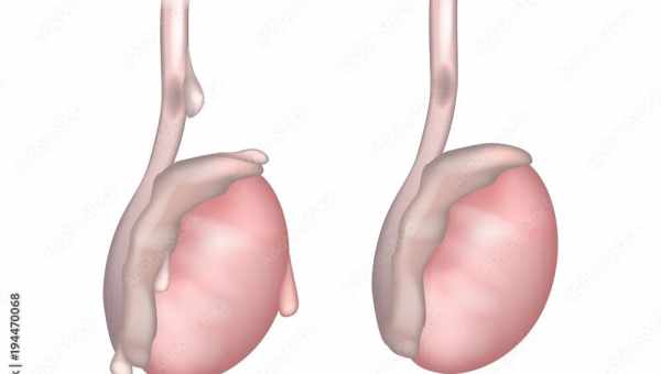 Как проявляется рак яичка у мужчин: симптомы. Когда бить тревогу, к кому обращаться с раком яичка у мужчины