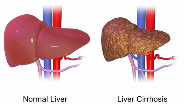 Как проявляется цирроз печени у мужчин: симптомы и признаки. Как выявить и чем лечить цирроз печени у мужчины