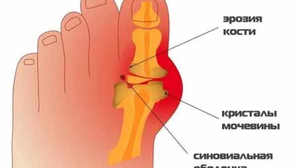 Подагра: народные средства для вывода излишка мочевой кислоты из организма. Как вылечить подагру народными средствами?