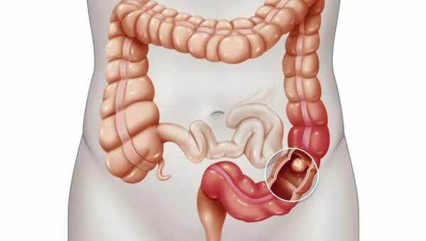 Что делать при воспалении сигмовидной кишки? К какому врачу обращаться, как лечиться, если началось воспаление сигмовидной кишки