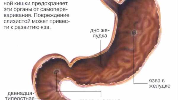 Воспаление слизистой желудка (гастрит): причины появления и симптомы. Как лечить воспаление слизистой желудка?