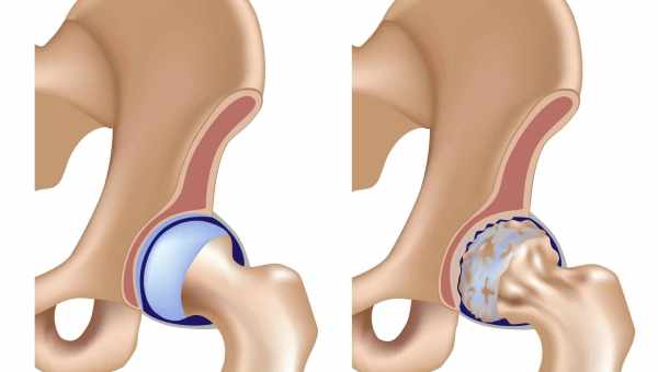 Воспаление тазобедренного сустава: причины, симптомы, возможные осложнения. Методы лечения воспаления тазобедренного сустава