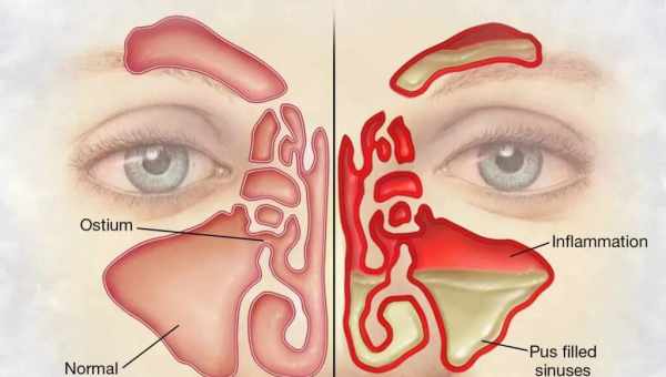 Воспаление слизистой носа: причины, симптомы. Методы лечения воспаления слизистой носа: советы врача