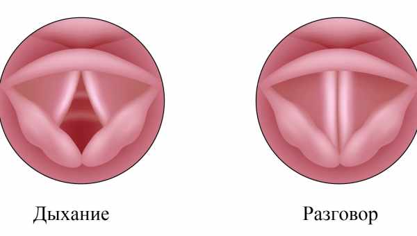 Воспаление голосовых связок: причины, симптомы. Методы лечения воспаления голосовых связок
