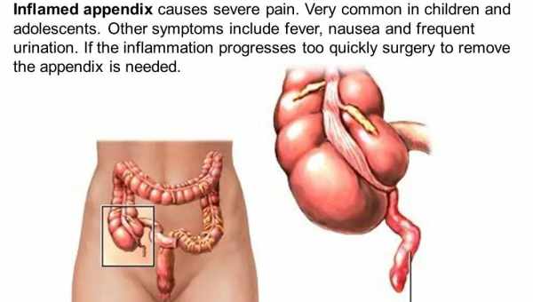 Воспаление аппендикса — причины, как избежать осложнений. Симптомы и методы лечения воспаления аппендикса