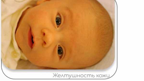 Желтуха новорожденных. Диагностика, лечение, последствия и профилактика желтухи новорожденных